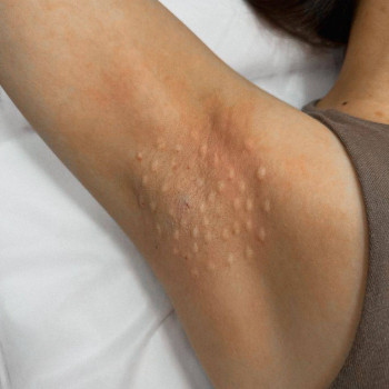 Ботоксльвів