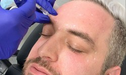 Ботулінотерапія Салон краси Be cute Київ