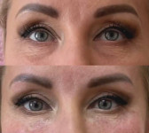 Заповнення носослізної борозни Дерматолог косметолог Нелли Київ