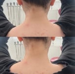 Ботулінотерапія TrapTox Дерматолог косметолог Нелли Киев