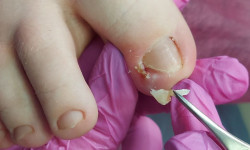 Обробка врослого нігтя Салон красоты Наоми Кривой Рог