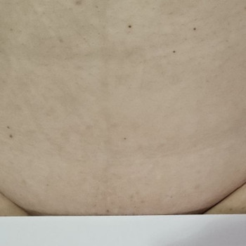 бікіні після трьох процедур