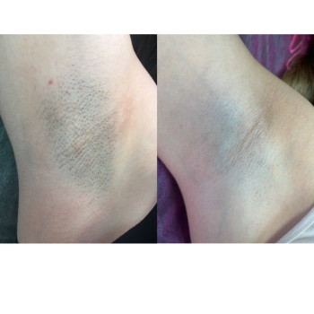 Лазерна епіляція до/після 5 процедур
