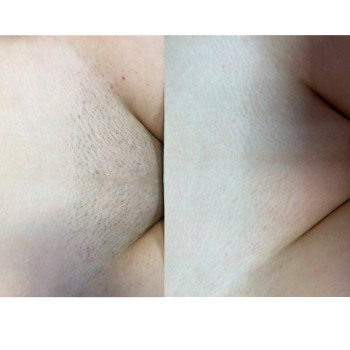 Лазерна епіляція до/після 6 процедур