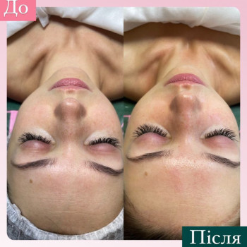 HydraFacial