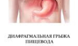 ГЕРБ - Рефлюкс - эзофагит Кінезітерапевт Сергей Кривий Ріг