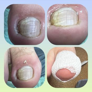 Не терпи біль. Приходь на прийом!!! Я допоможу вирішити проблему з врослим нігтем!!