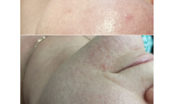 Комбинированая чистка Косметолог Татьяна Київ