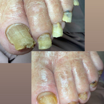 Педикюр подологічний з обробкою грибкових нігтів