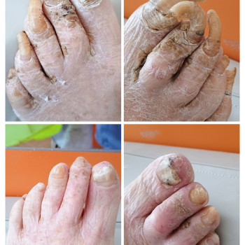 Онихогрифоз,возрастная деформация