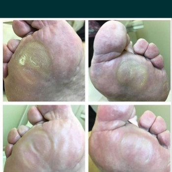 Подошвенная мозоль