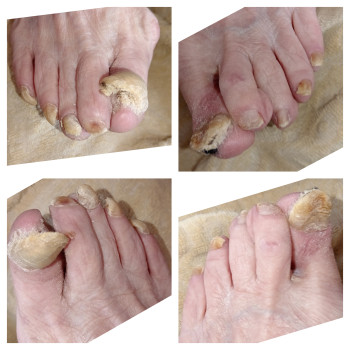 Онихогрифоз