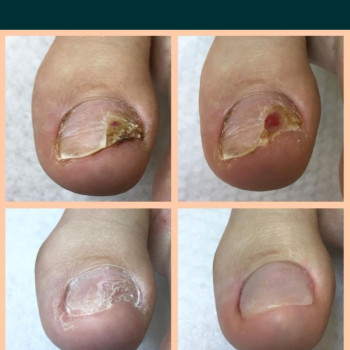 Лечение онихолизиса