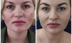 Скульптурний масаж обличчя Косметолог-инъекционист Людмила Киев