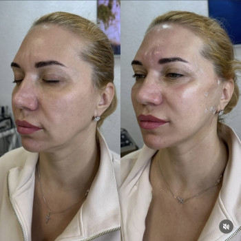 Нитковий ліфтинг
