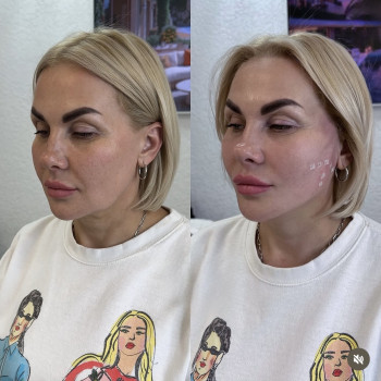 Нитковий ліфтинг