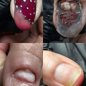 7 МІСЯЦІВ НА ШЛЯХУ ДО ЗДОРОВ'Я Сьогодні я з гордістю ділюся результатом. Пройшло довгих 7 місяців щомісячних зустрічей, кропіткої зачистки, правильного домашнього догляду та, найголовніше, — терпіння та дисципліни моєї клієнтки. Що ми маємо сьогодні: Повністю здорове нігтьове ложе. Рівну, чисту нігтьову пластину. Жодних ознак порожнечі чи оніхолізису. Відсутність будь-якої інфекції. Як вам такий результат? Напишіть у коментарях якщо вважаєте, що це варте витраченого часу!