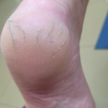 трещиннапятках вднепре