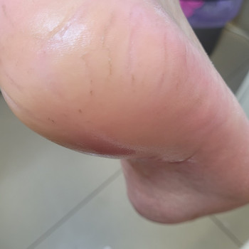 трещиннапятках вднепре