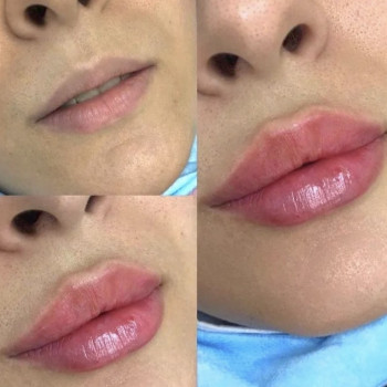 Ніжний обʼєм, природна форма 💋 Підкреслюємо красу, а не змінюємо її Збільшення губ без «перекачаного» ефекту