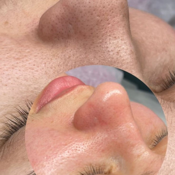 Чиста шкіра — найкраща база для краси ✨ Догляд, який видно одразу Менше висипань, більше впевненості Запис у direct 📩