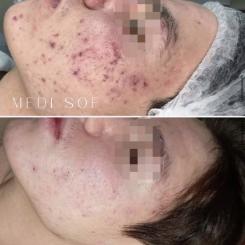 Лікування акне — це процес, а не один візит 💆‍♀️ Індивідуальний підхід + правильний догляд Запис у direct 📩