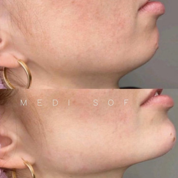 Чіткі лінії, гармонійні пропорції ✨ Контур, який підкреслює твою природну красу Вилиці, підборіддя, овал — усе продумано до деталей