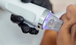 Голковий RF-ліфтинг Студия лазерной эпиляции Центр лазерної косметології Луцк