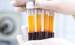 Плазмотерапія PRF Студия лазерной эпиляции Центр лазерної косметології Луцк