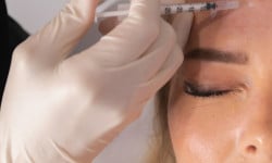 Ботулінотерапія Full Face / Allergan botox Студия лазерной эпиляции Центр лазерної косметології Луцк