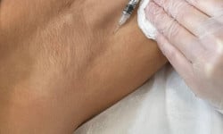 Ботулінотерапія при гіпергідрозі підпахв Студия лазерной эпиляции Центр лазерної косметології Луцк