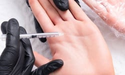 Ботулінотерапія при гіпергідрозі долонь Студия лазерной эпиляции Центр лазерної косметології Луцк