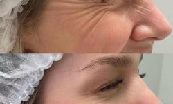 Ботулінотерапія Allergan 1 ділянки Студия лазерной эпиляции Центр лазерної косметології Луцк