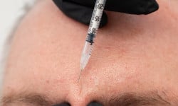 Ботулінотерапія Rentox 1 ділянки Студия лазерной эпиляции Центр лазерної косметології Луцк
