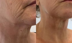 NEOTIVA Collagen - біостимуляція шкіри Студия лазерной эпиляции Центр лазерної косметології Луцк