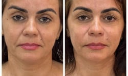 Біоревіталізація NCTC 109 від Mesoestetic Студия лазерной эпиляции Центр лазерної косметології Луцк