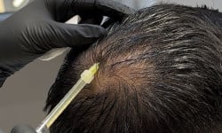Мезотерапія шкіри голови Dermaheal HL Студия лазерной эпиляции Центр лазерної косметології Луцк