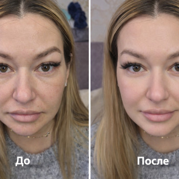 Контурная пластика