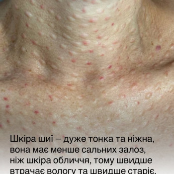 Біоревіталізація шкіри,це про ущільнення та про якість.