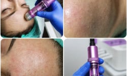 Электропорация (безинъекционная мезотерапия) Косметолог Анна Вінниця