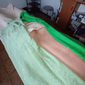 Робота з біологічно активними точками для відновлення нервової провідності та покращення кровообігу. Використання стерильних одноразових голок гарантує безпеку, а точне знання анатомії забезпечує швидкий терапевтичний результат. ​