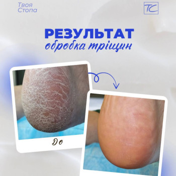 Фото с портфолио Твоя стопа