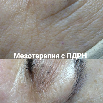 Мезотерапія з Полінукліотидами