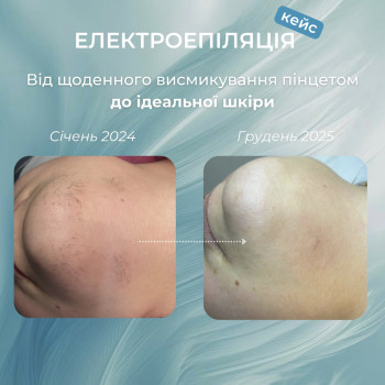 Результати електроепіляції
