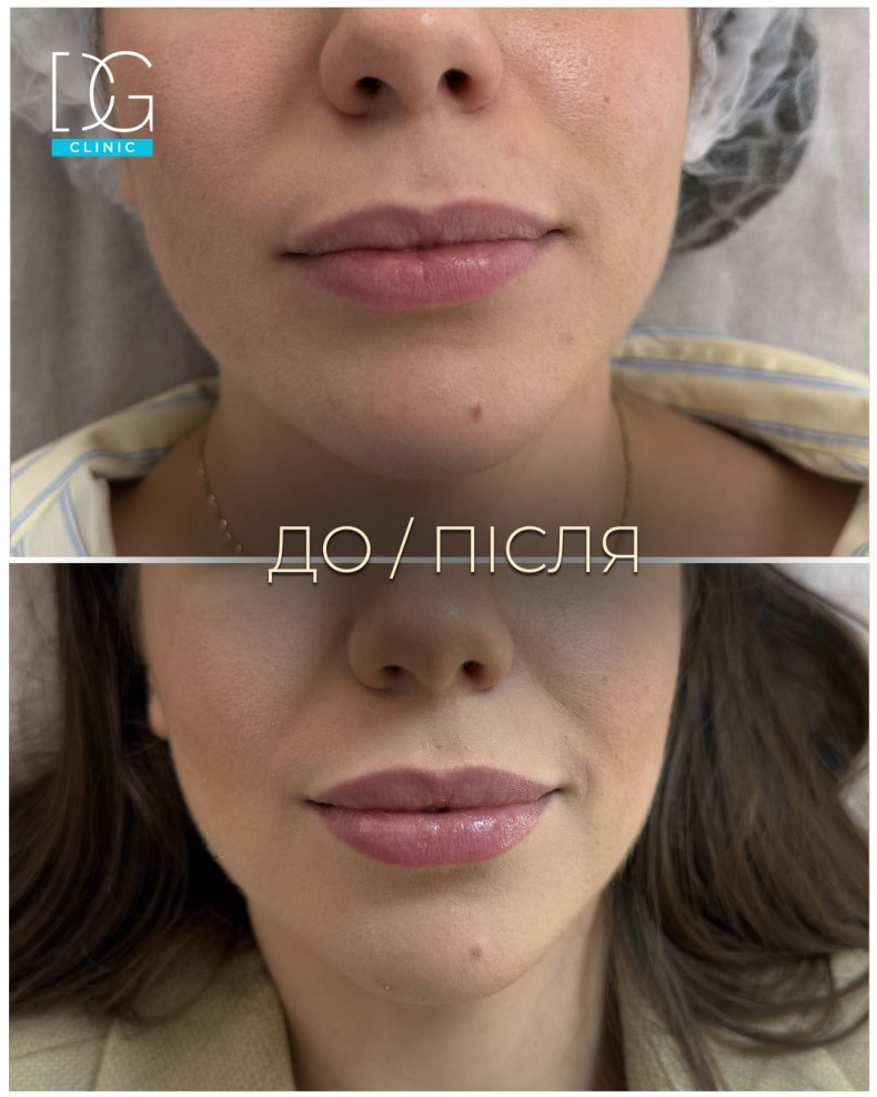 Увеличение губ контурная пластика аугментация, фото - Косметология Dr. Galatska clinic