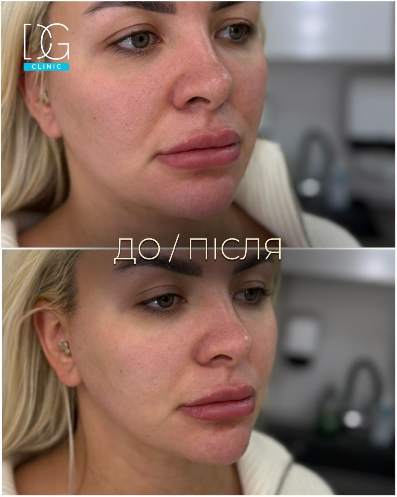Увеличение губ контурная пластика аугментация, фото - Косметология Dr. Galatska clinic