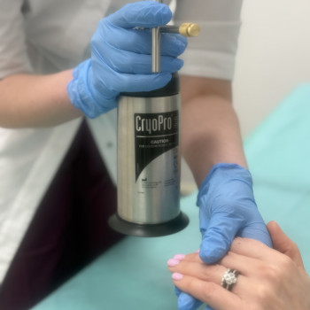 Кріодеструкція на апараті CRYOPRO — сучасний та ефективний метод лікування вірусних бородавок, мозолів та інших шкірних утворень.