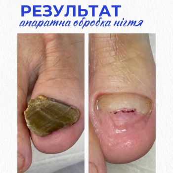 Оніхогрифоз, подологія