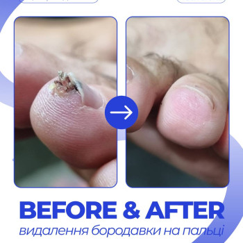 Бородавка, подолог