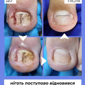 Врослий ніготь, подолог, корекційна система